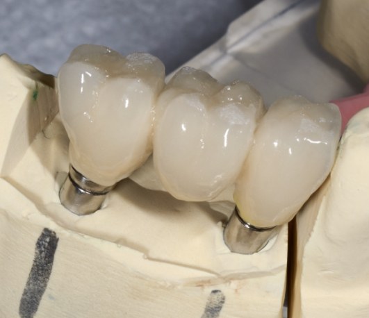 Ceramist creating a three part dental bridge