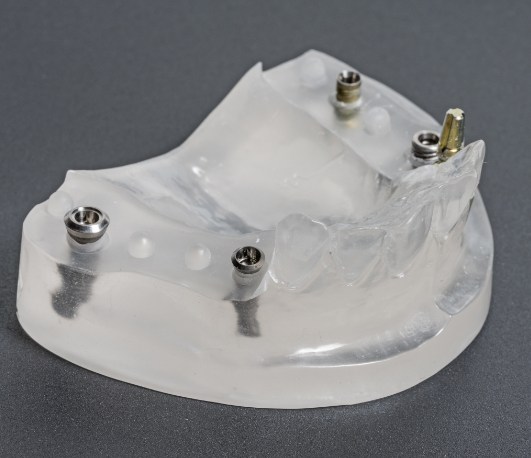 Model of the lower jaw with four dental implants