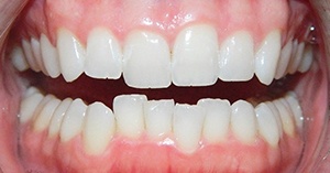 Mouth with misaligned lower teeth