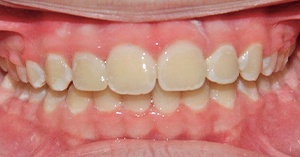Mouth after treating chipped teeth