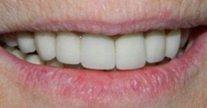 Row of white teeth after dental treatment