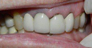 Row of teeth with gray stripes near the gums