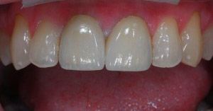 Row of whiter straighter teeth