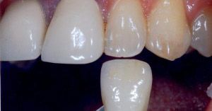 Veneer being held near a row of discolored and slightly misaligned teeth