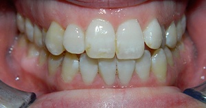 Mouth with slightly uneven teeth and slight overbite