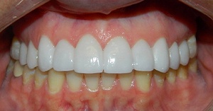 Mouth after teeth whitening