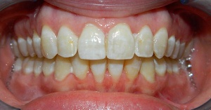 Mouth with more well aligned and whiter teeth
