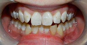 Mouth with misaligned and stained teeth