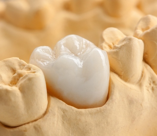 White dental crown over a tooth in a model of the mouth