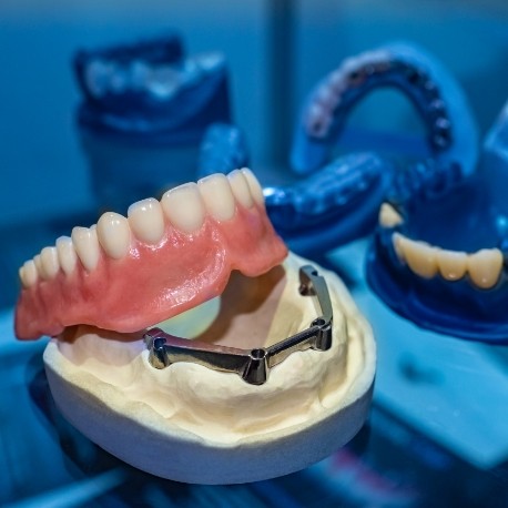 Model of implant dentures