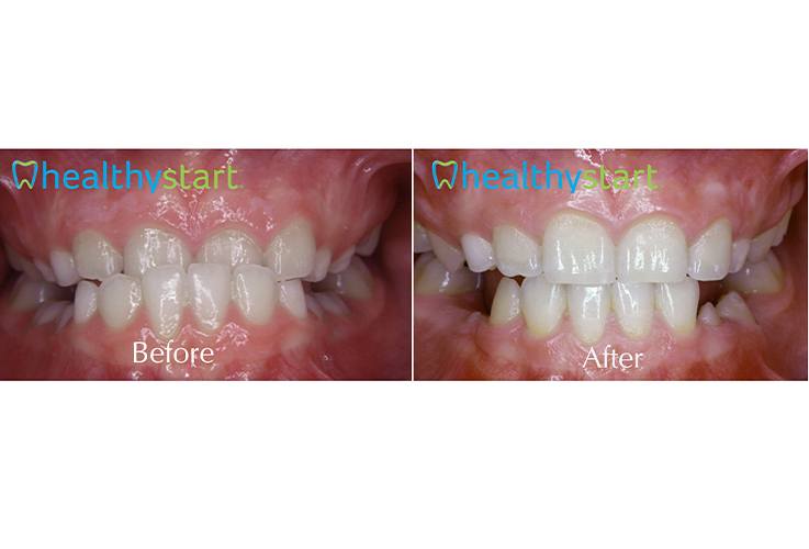 Close up of childs mouth before and after aligning teeth with Healthy Start