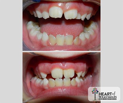Close up of mouth before and after aligning teeth with Healthy Start