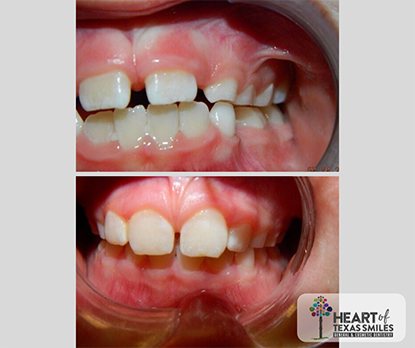 Close up of mouth before and after aligning bite with Healthy Start