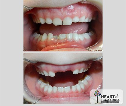 Close up of mouth before and after aligning jaws with Healthy Start