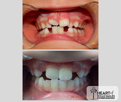 Close up of mouth before and after orthodontic treatment with Healthy Start