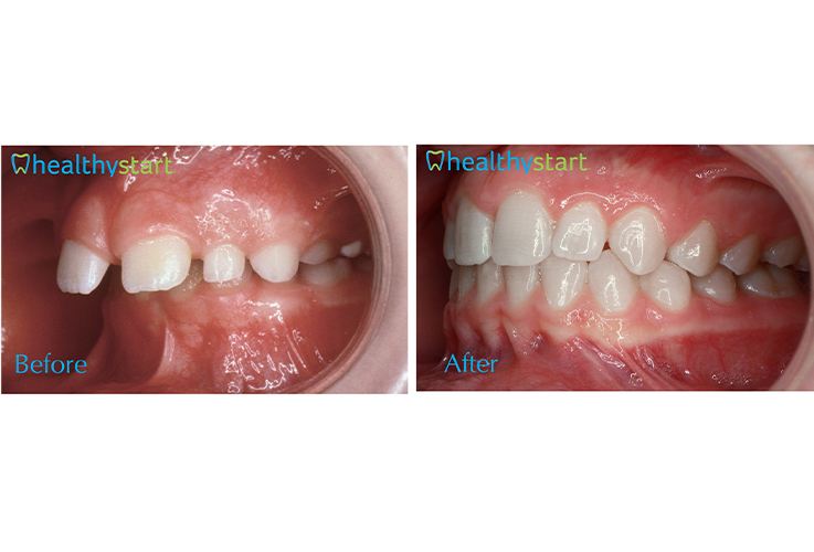 Mouth before and after aligning teeth with Healthy Start