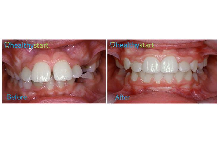 Close up of mouth before and after treatment with Healthy Start