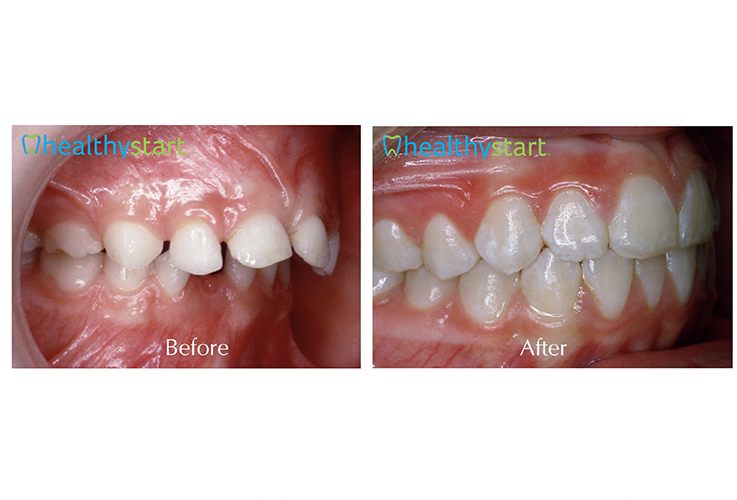 Close up of mouth before and after aligning teeth with Healthy Start treatment