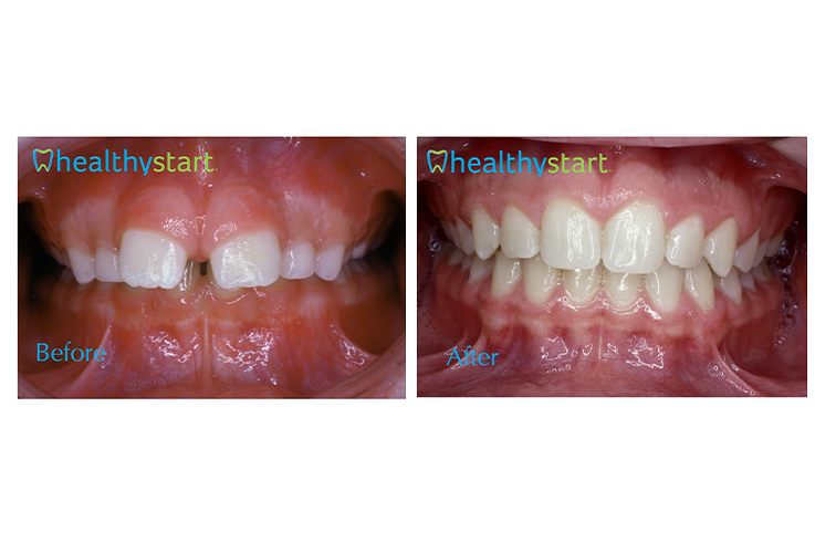 Close up of mouth of child before and after aligning teeth with Healthy Start