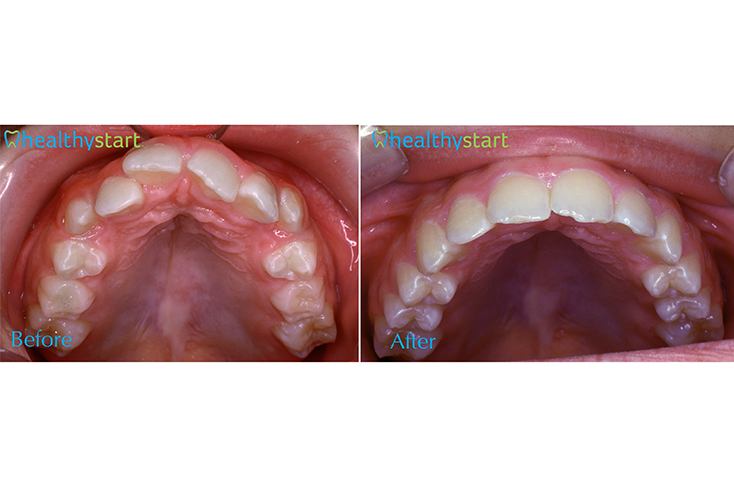 Close up of arch of teeth before and after aligning teeth with Healthy Start