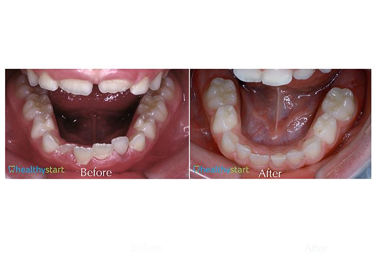 Close up of lower arch of teeth before and after treatment with Healthy Start