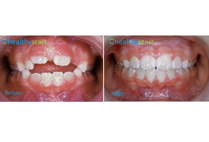 Close up of child dental patient before and after aligning teeth with Healthy Start