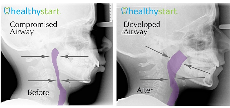 X ray of airway before and after Healthy Start treatment