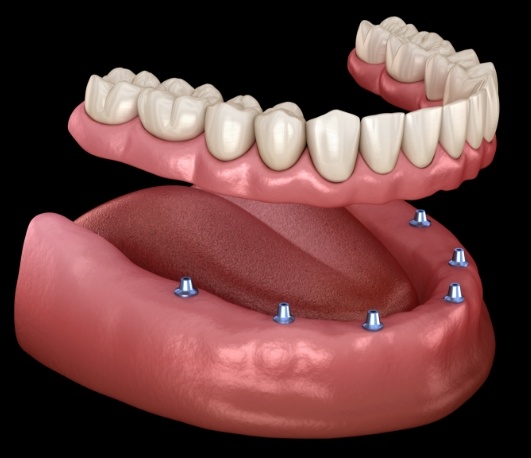 Illustrated full denture being fitted onto six dental implants