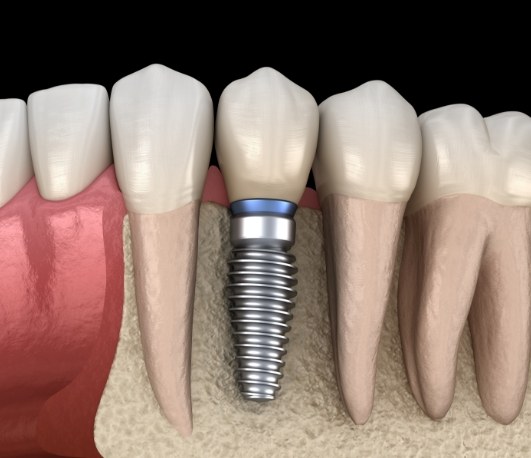 Illustrated dental implant replacing a missing lower tooth