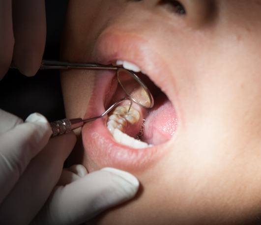 Close up of a patient receiving a dental exam
