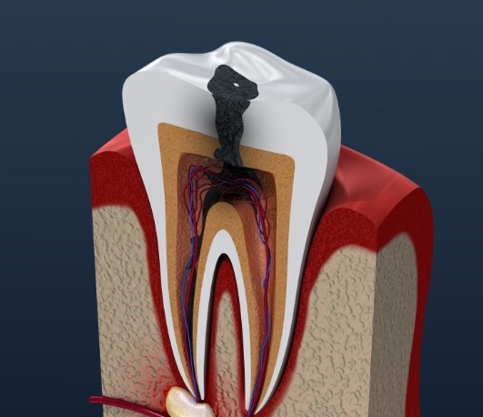Illustration of decayed tooth that needs root canal treatment in Waco