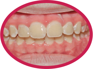 After Invisalign