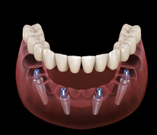 Illustrated full denture being fitted onto four dental implants