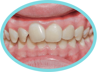 Before Invisalign