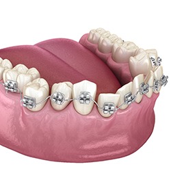 Illustration of braces attached to crooked teeth in lower arch