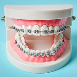 Dental model with braces in Waco against blue background