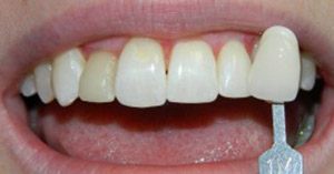 Veneer being held near row of slightly discolored teeth