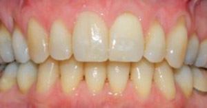 Mouth after treating tooth stains