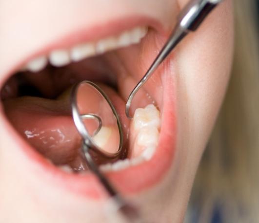 Close up of child receiving a dental exam