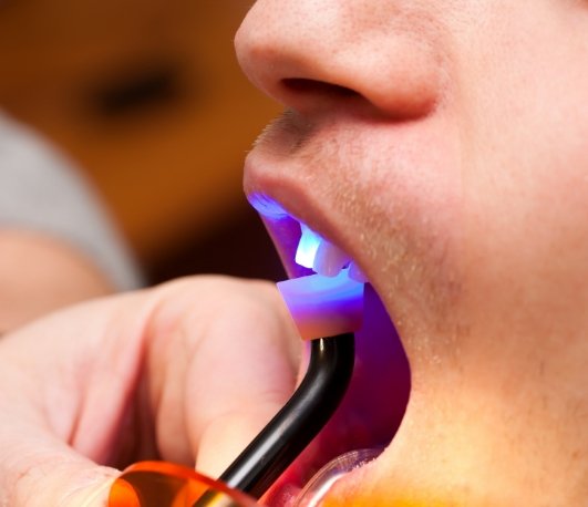 Close up of dental patient getting cosmetic bonding on front upper tooth