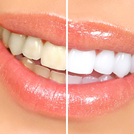 before and after teeth whitening
