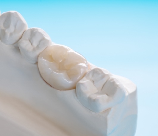 White dental crown over a tooth in a model of the mouth