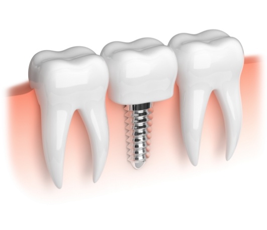 Illustrated dental implant in the jaw in between two natural teeth