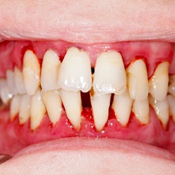 A mouth with gum disease.