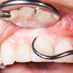 A patient receiving scaling and root planing treatment.
