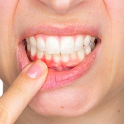 A person with mild gum disease.