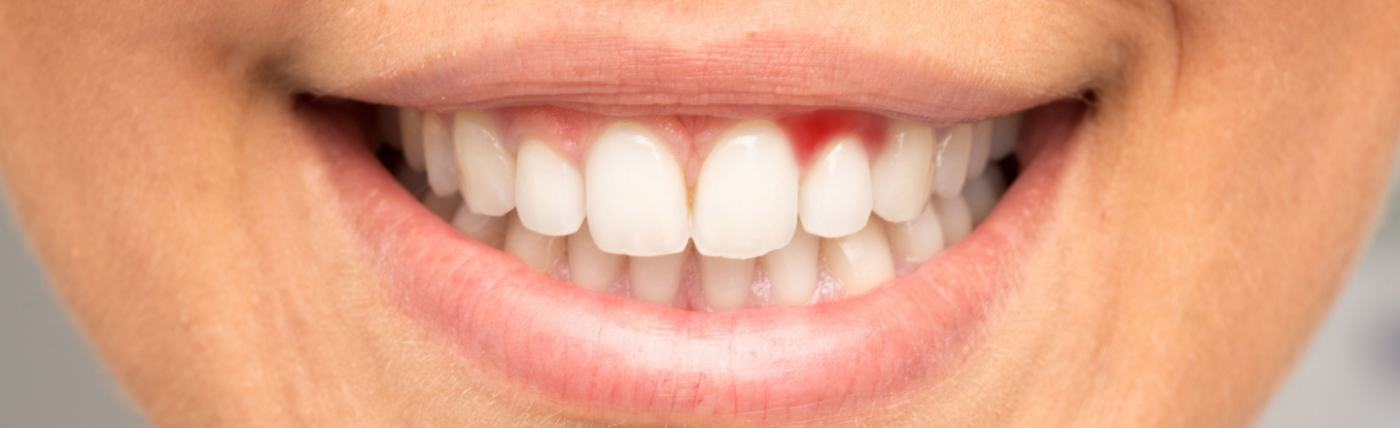 Close up of smile with red spot in the gums before gum disease treatment