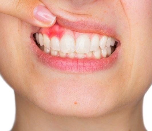 Person pointing to red spot in their gums