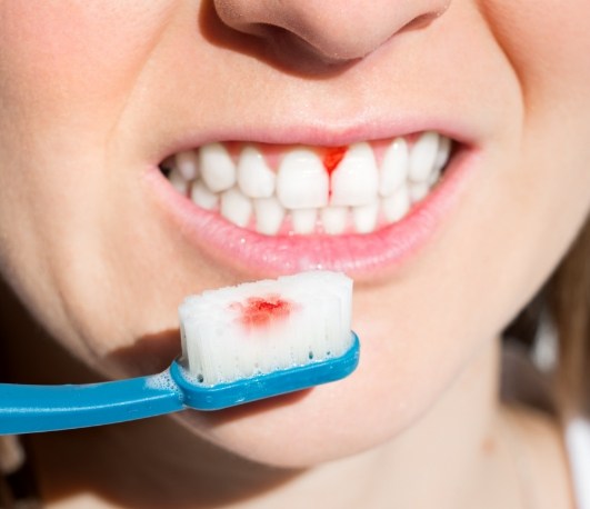Person holding bloody toothbrush near their mouth with bleeding gums