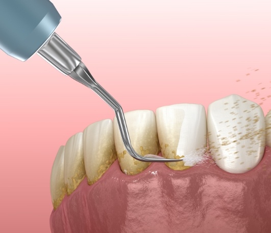 Illustrated dental scaler clearing plaque buildup from teeth